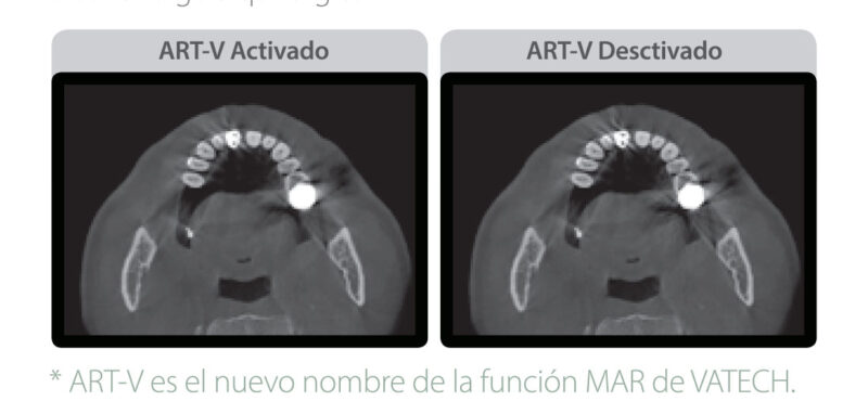 Rayos X dental precio Green 16/18 reduce el artefacto metalico