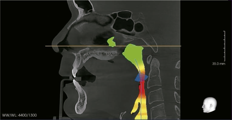 Bonceph el mejor software para análisis de vías aéreas.