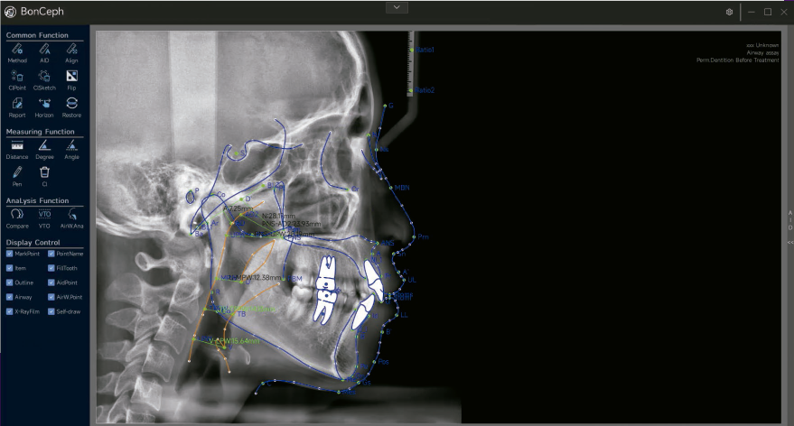 Software para estudio Cefalométrico BondentCeph.
